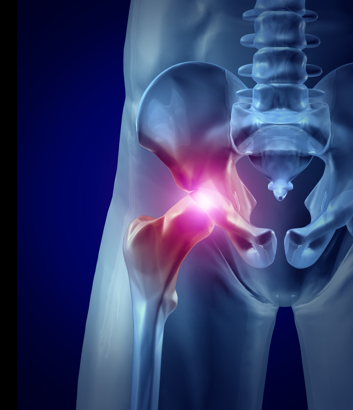 Arthroplasty (hip replacement) both primary and revision.