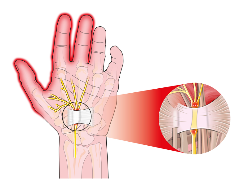 All upper and lower nerve compressions and peripheral nerve reconstruction.