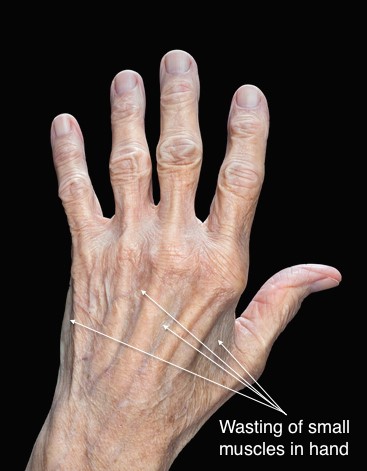 Photograph of a hand showing wasting of the small muscles from chronic ulnar nerve compression