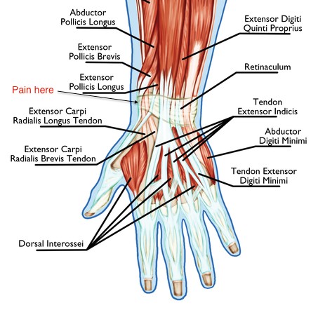 Illustration of the back of the hand and wrist showing the EPB and APL tendons involved in De Quervain's tenosynovitis
