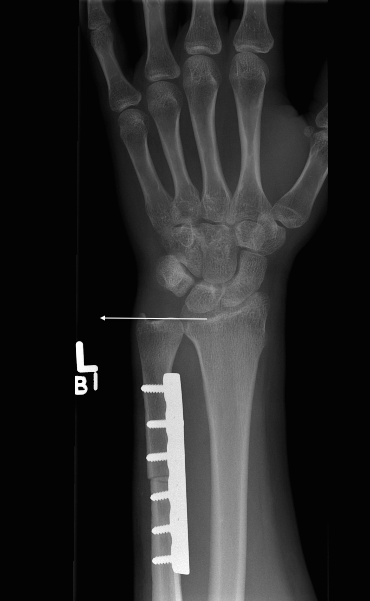 X-ray showing DRUJ instability