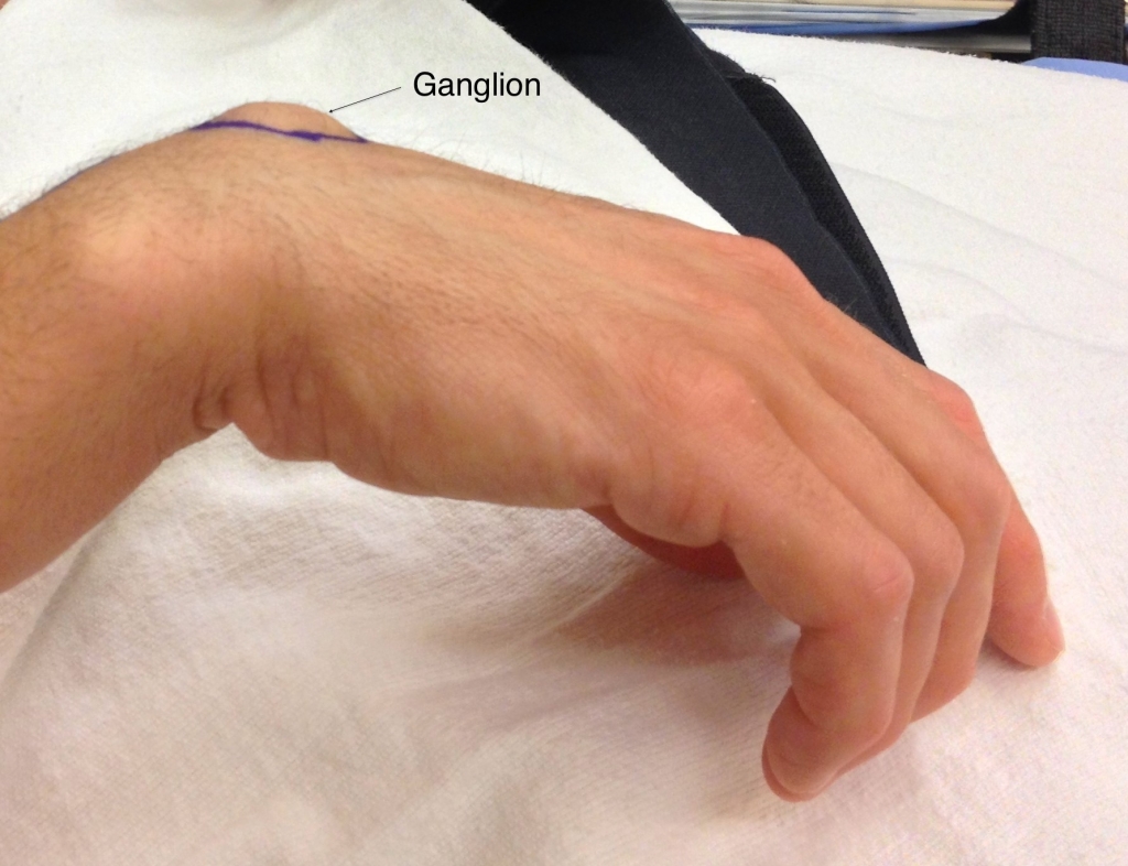 Photograph of a ganglion cyst on the back of the wrist