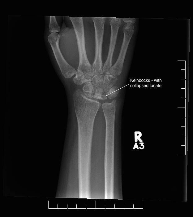 X-ray showing Kienböck's disease with a collapsed lunate