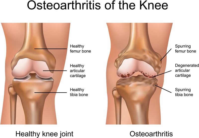 Osteoarthritis of the knee, comparing a healthy knee joint to one affected by osteoarthritis