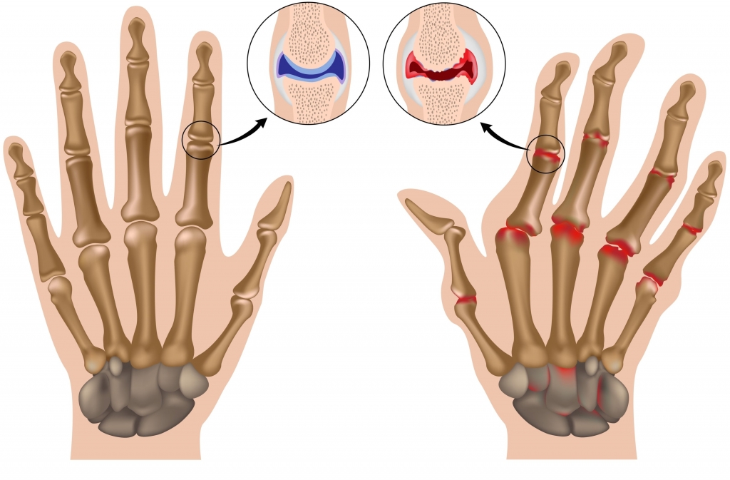 Illustration comparing a healthy hand to a hand affected by osteoarthritis