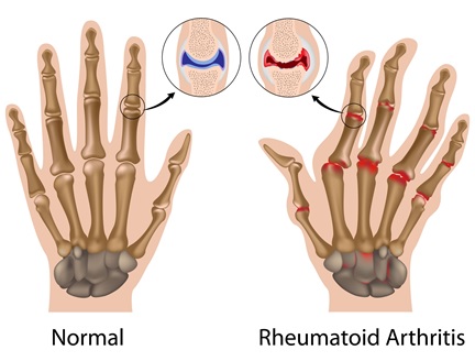 Illustration comparing a normal hand to one affected by rheumatoid arthritis
