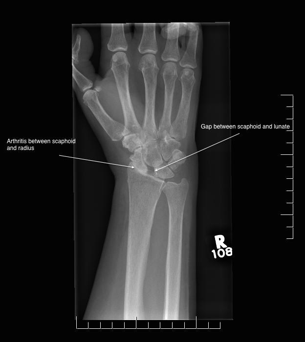 X-ray showing a SLAC wrist, with arthritis between the scaphoid and radius and a gap between the scaphoid and lunate