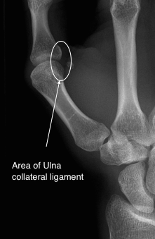 X-ray showing the area of the ulna collateral ligament of the thumb